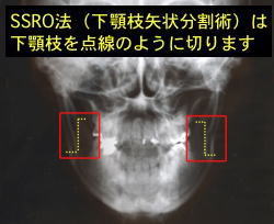 SSRO@̐؂